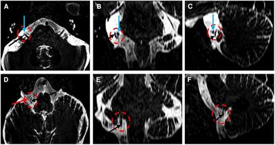 Microvascular decompression for intermediate nerve neuralgia: a case report and literature review